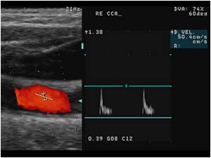 Abnormal high resistance doppler spectrum in the right common carotid artery