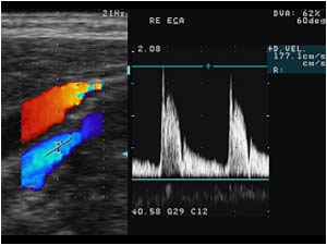 Right external carotid artery with increased flow