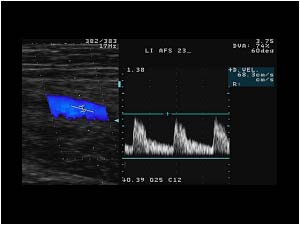 Doppler signal in the proximal superficial femoral artery with high diastolic flow