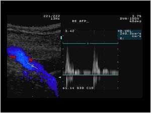Doppler signal in the deep femoral artery