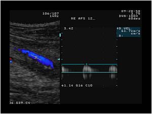 Post occlusion doppler signal in the patent distal superficial femoral artery