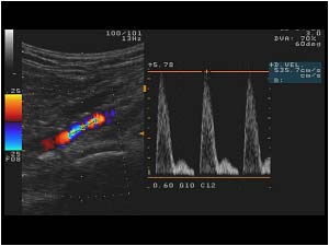High velocities in the stenosis
