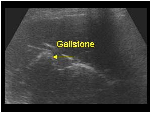 Gallstone and air in the intrahepatic bile ducts