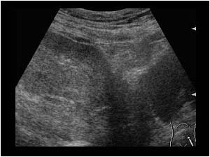 Single pelvic kidney posterior cranial to the bladder