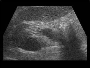 Pseudotumor caused by an abnormal rotation transverse