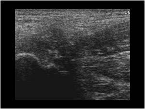 Thickened tendon insertion with calcifications longitudinal