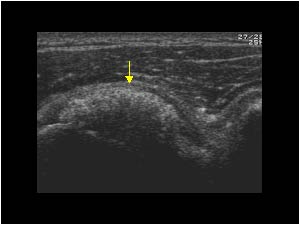 Subscapularis tendon with massive calcifications transverse