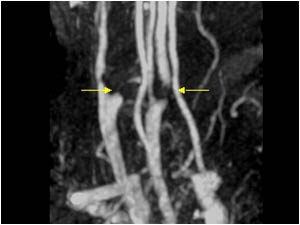 Internal carotid artery occlusion