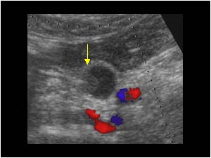 Ureter carcinoma with extension in the ureter transverse
