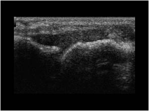 Synovial joint thickening MCP joint