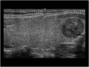 Papillary thyroid carcinoma with calcifications longitudinal