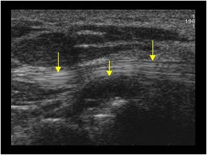 Arthrosynovial cyst and flexor tendon longitudinal