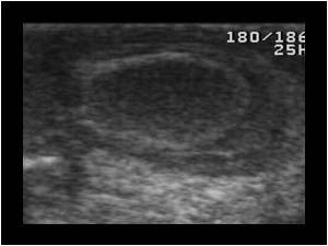 Right testicle with calcifications in the tunica vaginalis longitudinal