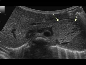 Extrapulmonary sequestration with a microcystic mass in the left upper abdomen transverse