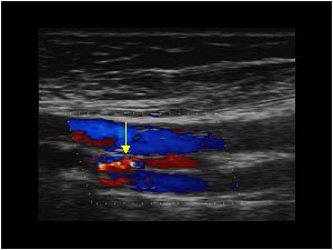 Small arterio venous fistula between the deep femoral artery and the common femoral vein longitudinal