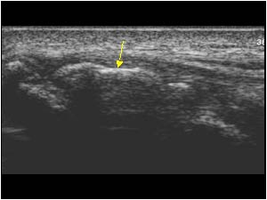 Large calcifications in the tendon longitudinal