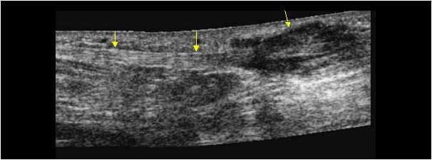 Large plantair fibroma in the distal plantar fascia longitudinal