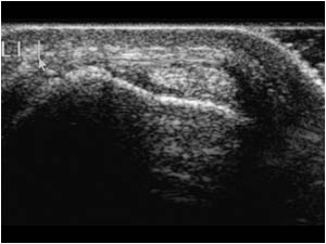 Normal extensor carpi ulnaris tendon transverse