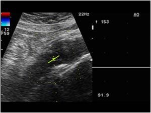 Occluded distal abdominal aorta without detectable flow