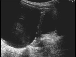Ovarian cyst and bladder longitudinal after voiding