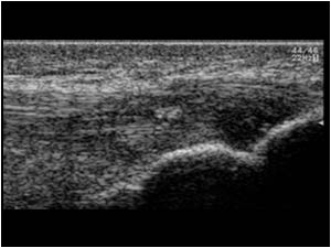 Distal insertion tendinopathy on the right side longitudinal