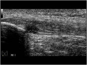 Apexitis in the left patellar tendon longitudinal