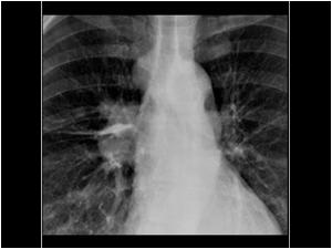 Chest X ray of the same patient with a hilar and mediastinal mass on the right side