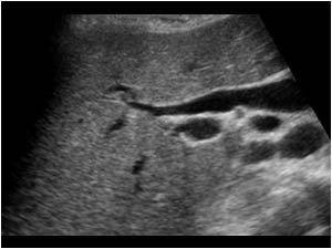 Normal intrahepatic ducts