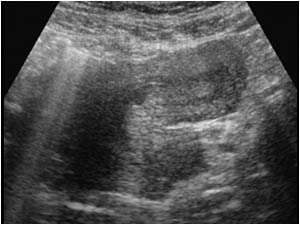 Bicornuate uterus longitudinal left horn