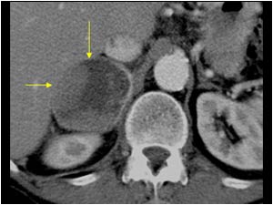 Case of the month March 2006: Adrenal metastases local invasion