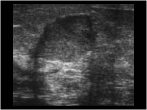 Case of the month May 2006: Atypical benign cysts