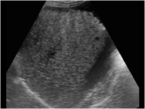 Liver cirrhosis with an irregular liver contour and ascites
