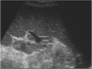 Enlarged lymphe nodes and splenomegaly
