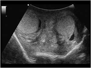 Edematous scrotal wall thickening