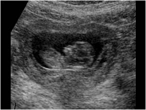 Intra uterine pregnancy
