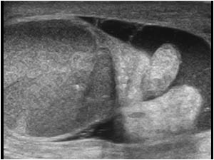 Inhomogeneous hypo-echoic testis and an epididymal knot