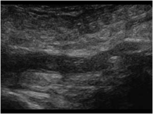 Thrombus in the common femoral vein longitudinal