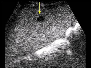 Hypoechoic lesion in the late phase