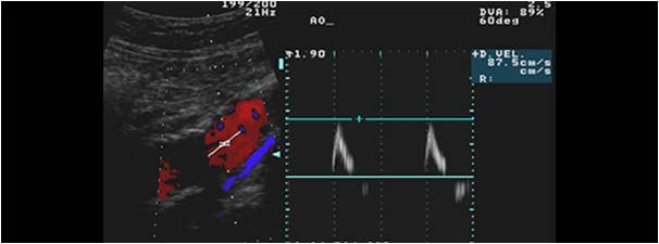 Normal doppler signal in the aorta