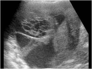 Ovarian carcinoma with a partly cystic mass