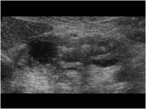 january 2002 - Cystic dilatated pancreatic duct