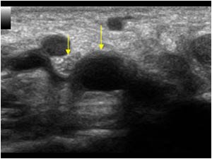 Ganglion cyst compressing the tibial nerve transverse