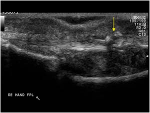 Sutures in the flexor pollicis longus tendon longitudinal