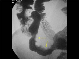 Abnormalities mimicking an acute appendicitis