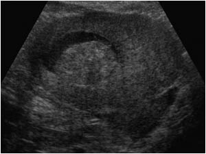 Another malignant lesion in the uterus that causes vaginal bleeding is the endometrial carcinoma. This image shows a mass and fluid in the endometrial cavity that proved to be an endometrial carcinoma.