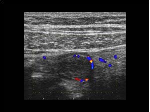 Transverse color doppler image of the appendix with some vascularity of the wall of the appendix.