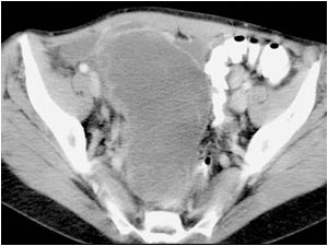 CT image of the same lesion showing a large mainly cystic mass.