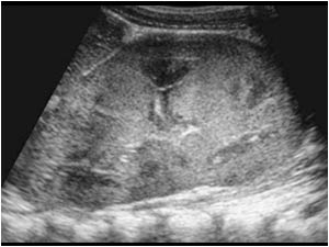 Longitudinal image of the enlarged left kidney.