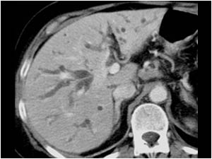 CT scan of the same patient showing dilatated intrahepatic bile ducts. The patient was suspected of having a bile duct carcinoma, in this location also known as Klatskin tumor. The prognosis is poor. The enlarged lymphe nodes are suggestive for metastases