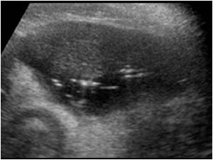 Transverse image of the lowerpole of the liver with peritoneal fluid and reflective structures.